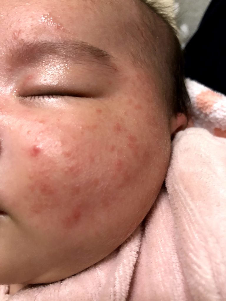 【乳児湿疹】赤ちゃんの肌きれいになるの？治らない？方法は？全て答えます！－こうりんまるBLOG